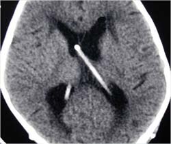 hydrocephalus treatment in noida